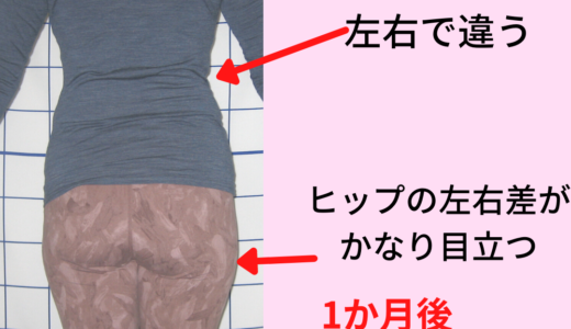 右だけ回るスカートが1か月で改善した例